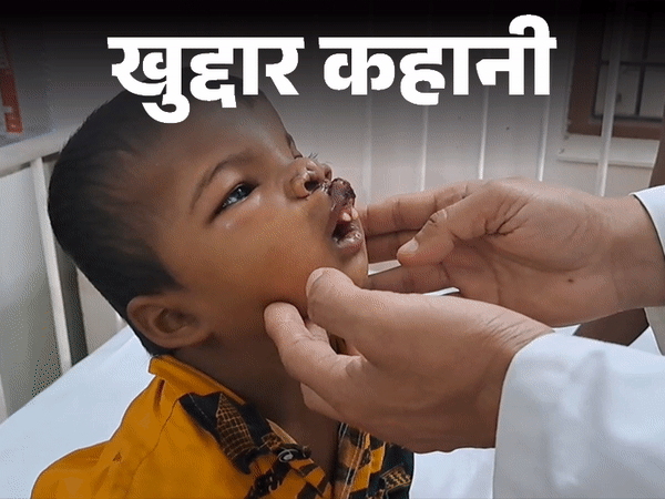 खुद्दार कहानी- साबुन और मोमबत्ती बेचता था:13 साल का था तब पिता गुजर गए, आज कटे होंठ वाले बच्चों की मुस्कान की वजह