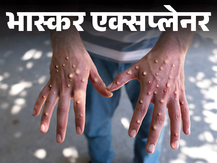 भास्कर एक्सप्लेनर- मंकीपॉक्स से डरना है या नहीं:अफ्रीका से चला वायरस पाकिस्तान तक पहुंचा, भारत को कितना खतरा; जानिए बचाव और लक्षण