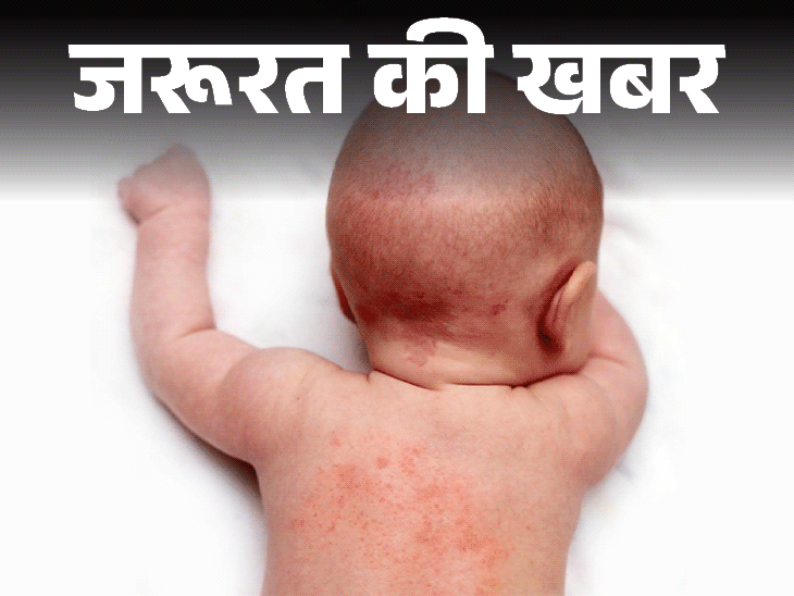 आप भी हैं घमौरियों से परेशान, अपनाएं ये घरेलू नुस्खे:छोटे बच्चों से लेकर बड़े-बुजुर्ग तक इसके शिकार, जानें इसकी वजह और बचाव