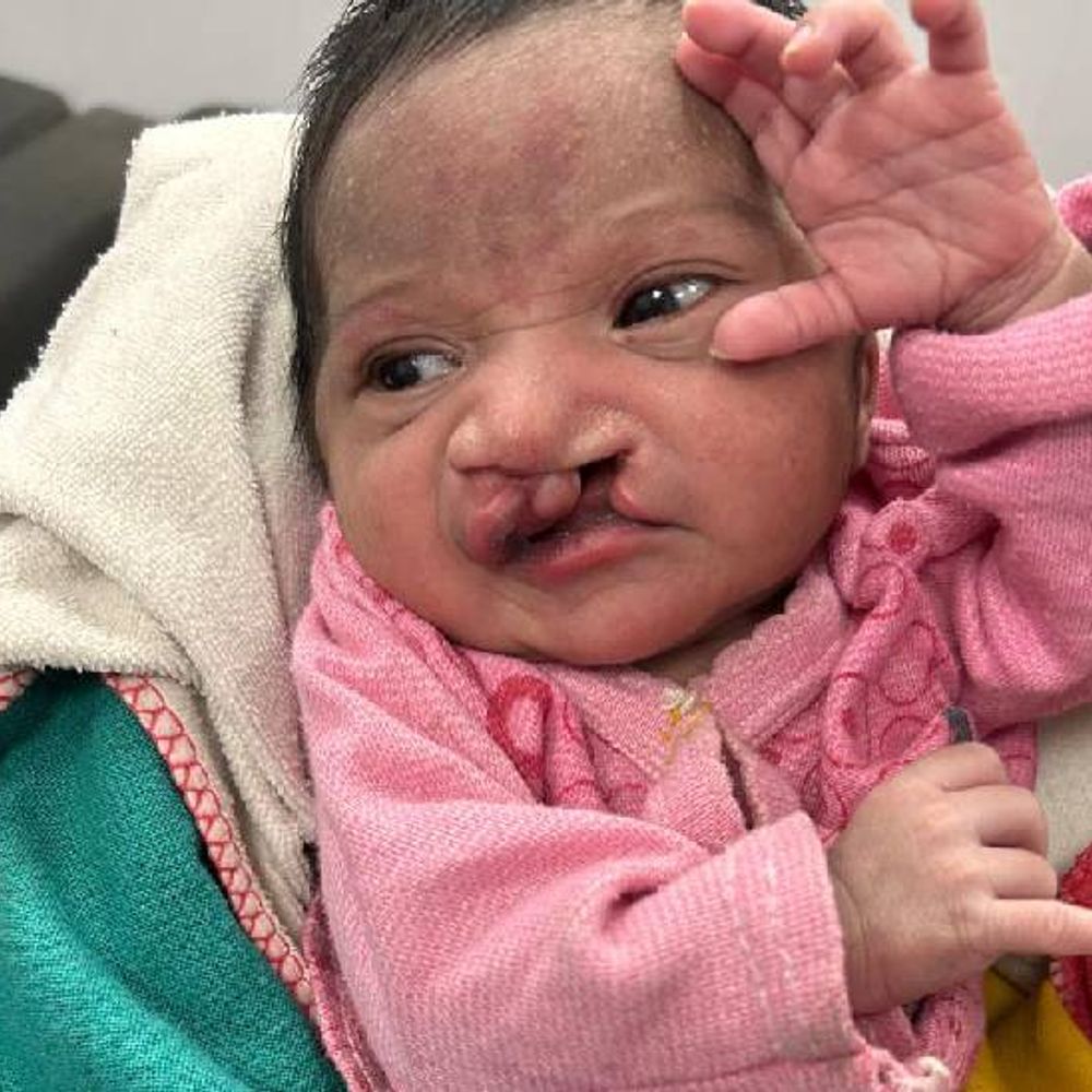 झांसी में 5 दिन की बच्ची को पालना में छोड़ा:होंठ-तालू कटा है, डॉक्टर बोले- इसी वजह से भयभीत होकर माता-पिता छोड़ गए, इलाज संभव