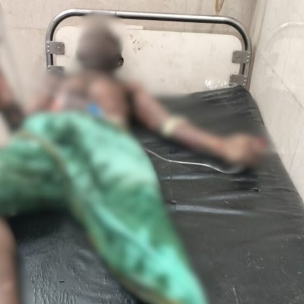 सीतापुर में आग से झुलसा युवक, मौत:बिल्डिंग के दौरान हादसे में घायल युवक ने ट्रामा सेंटर में तोड़ा दम