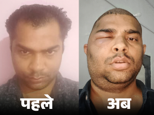 कानपुर में हेयर ट्रांसप्लांट दूसरे इंजीनियर की मौत:मां बोली-चेहरा सूजने लगा, आंखें बड़ी हो गई, मेरे गोद में तड़पता रहा, डॉक्टर ने ब्लॉक किया