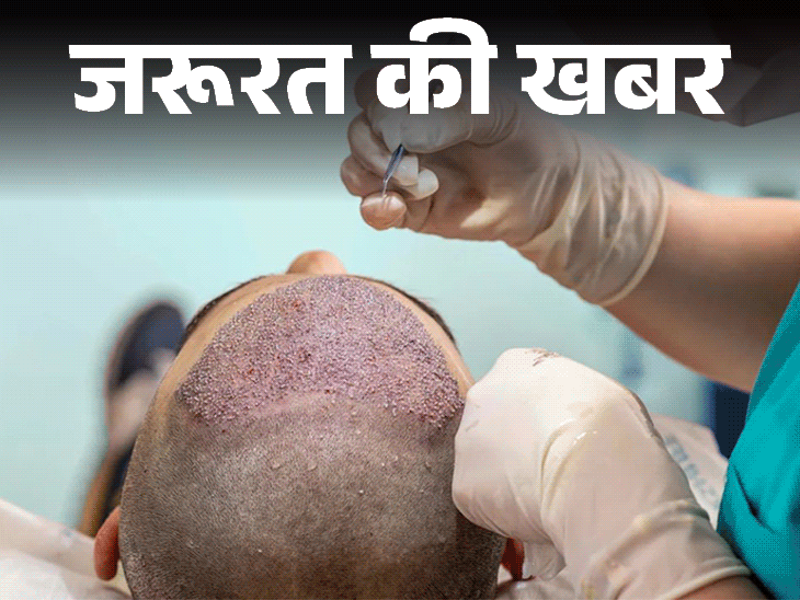 जरूरत की खबर- हेयर ट्रांसप्लांट के बाद 2 की मौत:क्या ये सर्जरी वाकई सेफ, कब हो सकती है खतरनाक, ये 7 सावधानियां जरूरी