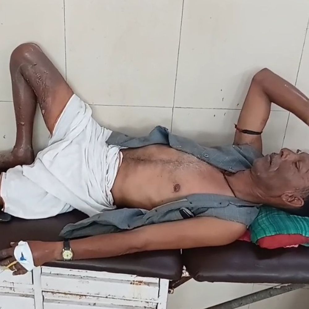 खाना बनाते समय गैस सिलेंडर से लगी आग:श्रावस्ती में महिला को बचाने आए ससुर भी झुलसे, दोनों का इलाज जारी