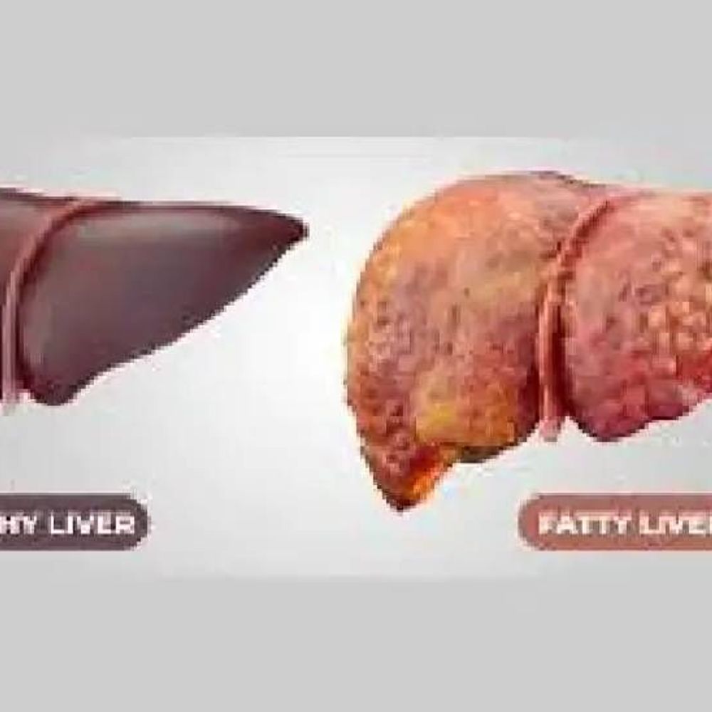 100 में से 17 पुरुष की कमर 90 सेमी निकली:महिलाओं की 80 सेमी से ज्यादा, नाॅन-अल्कोहलिक फैटी लिवर अभियान के तहत 11 हजार की हुई स्क्रीनिंग