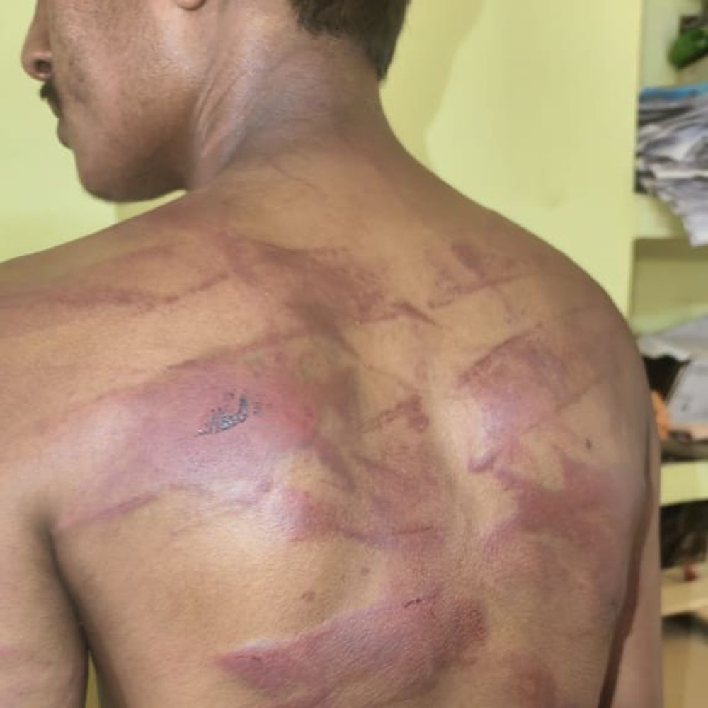 महराजगंज में युवक के साथ बेरहमी से मारपीट:जंगल में ले जाकर पीटा, पीड़ित अस्पताल में भर्ती
