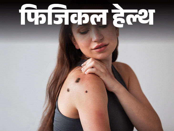 फिजिकल हेल्थ- रैशेज हो सकते हैं स्किन कैंसर का संकेत:इन संकेतों को कैसे पहचानें, डॉक्टर से जानें किन लोगों को ज्यादा खतरा