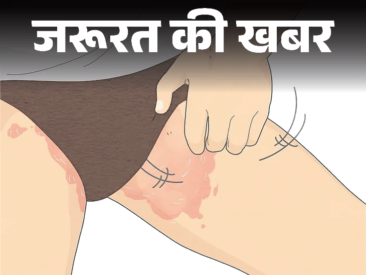 जरूरत की खबर- बारिश-उमस में बढ़ती थाई रैशेज की समस्या:इन 7 कारणों से होते रैशेज, डॉक्टर से जानें बचाव के लिए 8 जरूरी सावधानियां