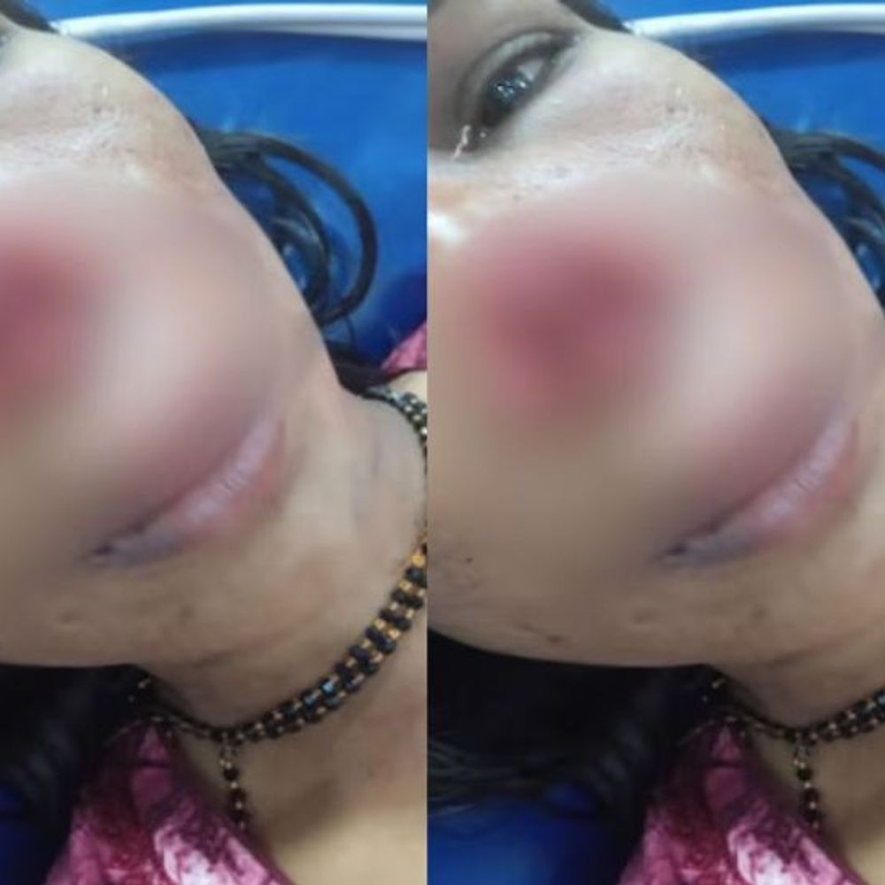 कर्नाटक में व्यक्ति ने पत्नी की नाक चबाई:कर्ज चुकाने को लेकर लड़ाई हुई थी; यूपी में डिप्टी डायरेक्टर ने इंजीनियर की नाक काटी थी
