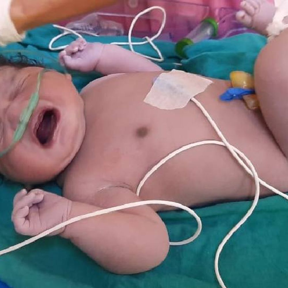 इंदौर में जन्मा प्रदेश का सबसे वजनी बच्चा:औसत से काफी बड़ा होकर वजन 5.43 किलो; मां का वजन 90 किलो, हाई ब्लड प्रेशर सहित अन्य तकलीफें