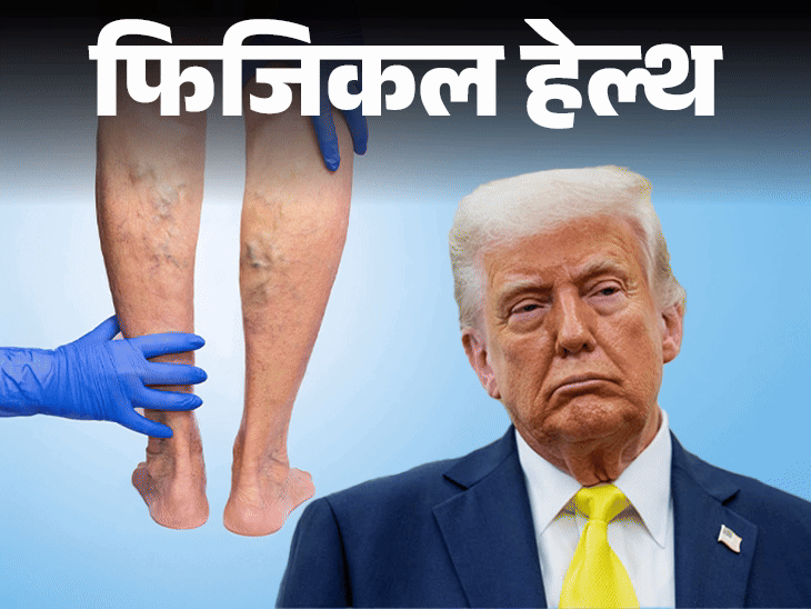 फिजिकल हेल्थ- डोनाल्ड ट्रंप को नसों की गंभीर बीमारी:क्या है CVI, जिसमें नसों में होती सूजन, बचने के लिए 10 सावधानियां जरूरी
