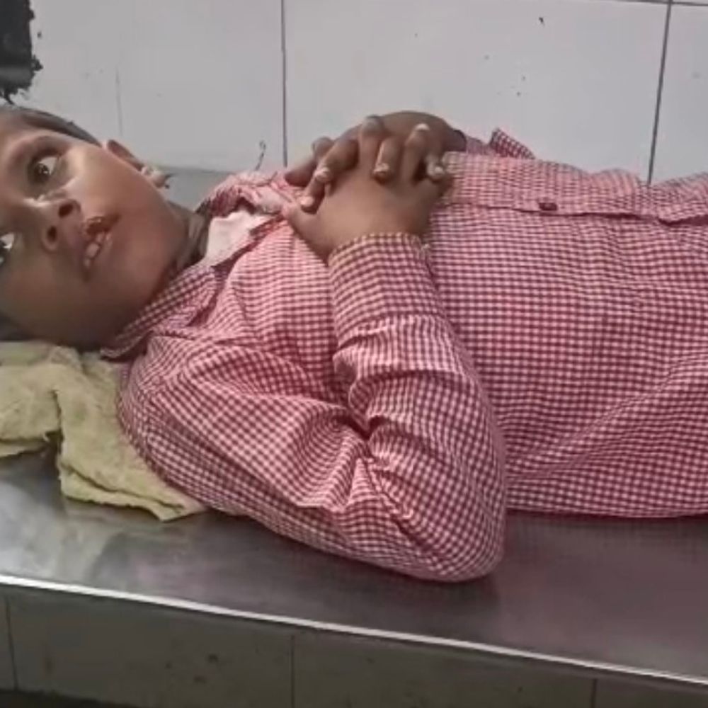 संभल में कुत्तों का आतंक से लोग परेशान:एक हफ्ते में 12 बच्चों पर किया हमला, हालत गंभीर