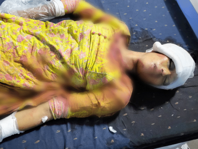 पूर्व कांग्रेस विधायक की नौकरानी ने खुद को गोली मारी:चित्रकूट में नीलांशु के घर में लाइसेंसी पिस्टल से किया फायर; 2 महीने बाद थी शादी