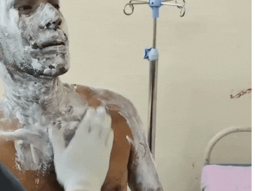 सिलेंडर लीक से झुलसे दो लोग:आगरा के पिनाहट कस्बे की घटना, आभूषण साफ करने के लिए खोला था सिलेंडर