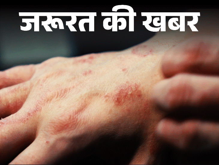 जरूरत की खबर- मानसून में बढ़ रहा स्किन इन्फेक्शन:नमी से बढ़ता बैक्टीरियल और फंगल इंफेक्शन, जानें बचाव और इलाज के टिप्स