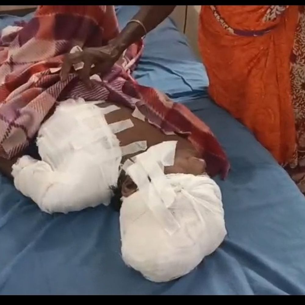 कुमारडूंगी में भालू ने किया हमला, किशोर घायल:  ग्रामीणों ने शोर मचाकर भालू को भगाया, चाईबासा सदर अस्पताल रेफर – Chaibasa (West Singhbhum) News