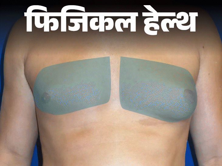 फिजिकल हेल्थ- पुरुषों के सीने पर स्तन जैसा उभार:क्या है गाइनेकोमेस्टिया, डॉक्टर से जानें किसे हो सकती है ये समस्या, कैसे बचें