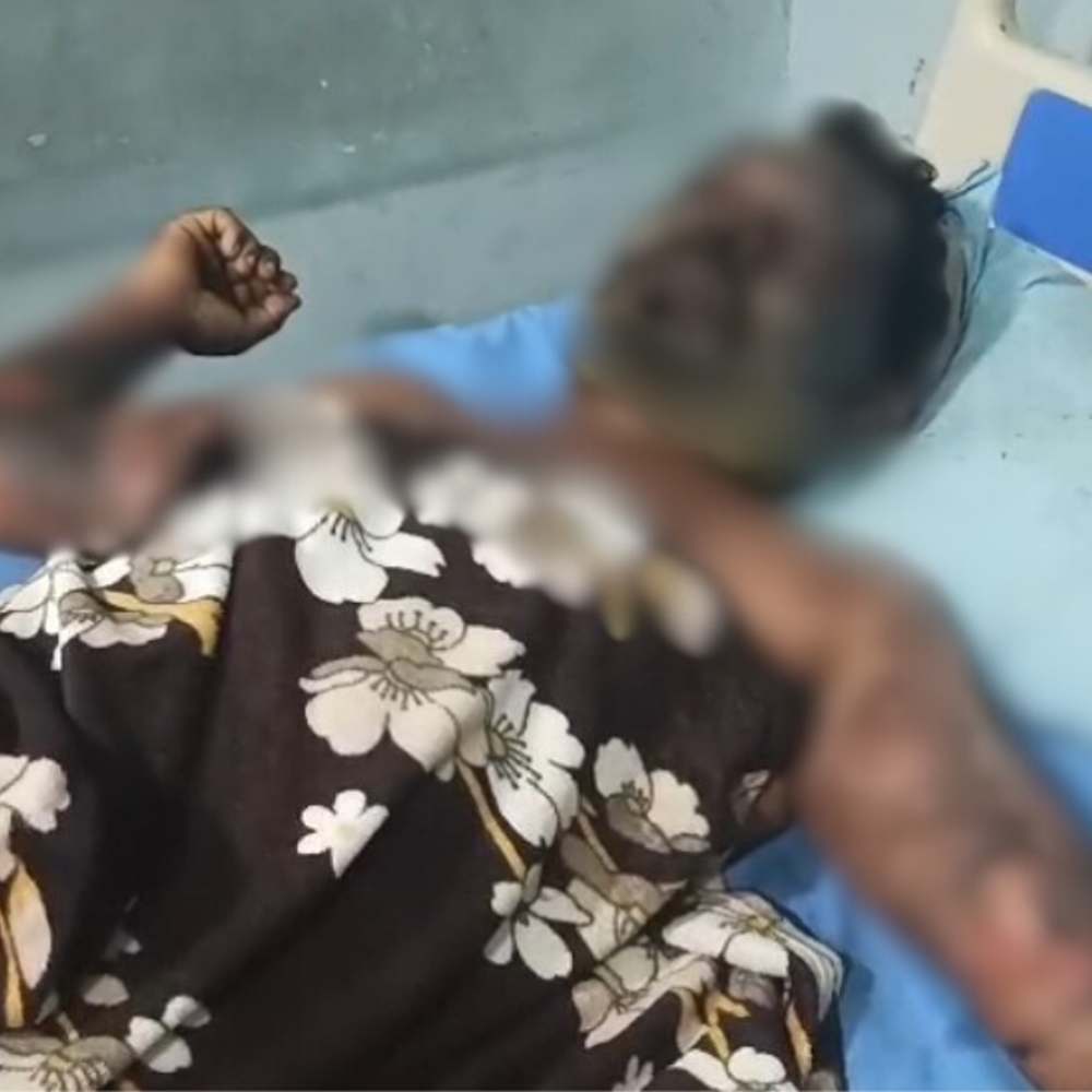 अमृतसर में दामाद को जलाने का आरोप:  ससुराल वाले बोले-खुद तेल डालकर आग लगाई, पत्नी से हुआ था झगड़ा – Amritsar News