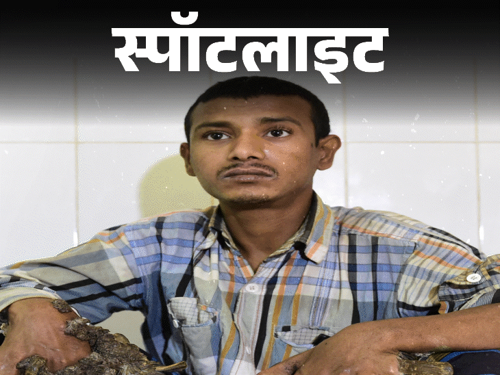 स्पॉटलाइट-लड़का बना पेड़, हाथ-पैर पर उगी छाल:परेशान शख्स ने अंग काटने की लगाई गुहार, ये कैसी बीमारी, देखें वीडियो