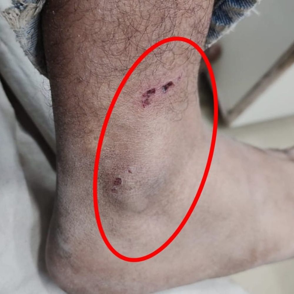 मोहाली में आवारा कुत्तों का हमला:  बुजुर्ग महिला और युवक के पैरों में काटा, लोगों ने प्रदर्शन करने दी चेतावनी दी – Mohali News