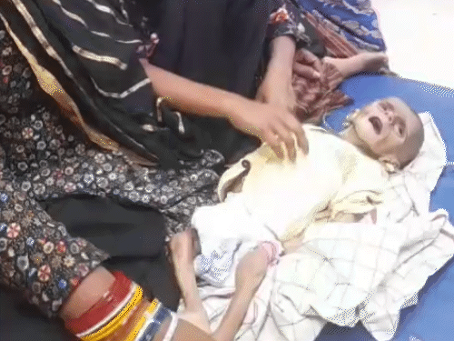 4 महीने के मासूम की चमड़ी हड्डियों से चिपकी:कुपोषण से वजन ढाई किलो, सतना जिला अस्पताल के पीआईसीयू में भर्ती