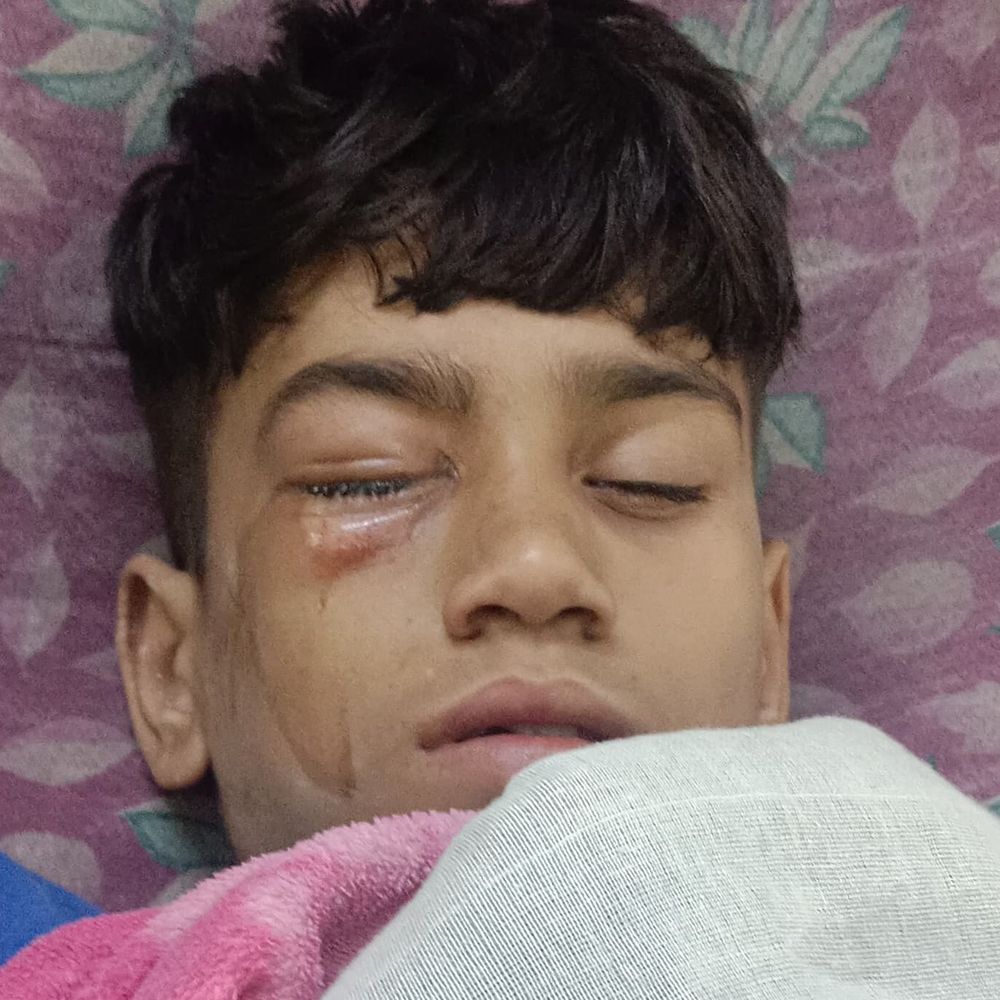 शाजापुर में घर में बना पटाखा बना जान का दुश्मन:छात्र की आंख की हालत गंभीर, डॉक्टर बोले- पैरेंट्स ALERT रहे, बच्चों पर ध्यान दें