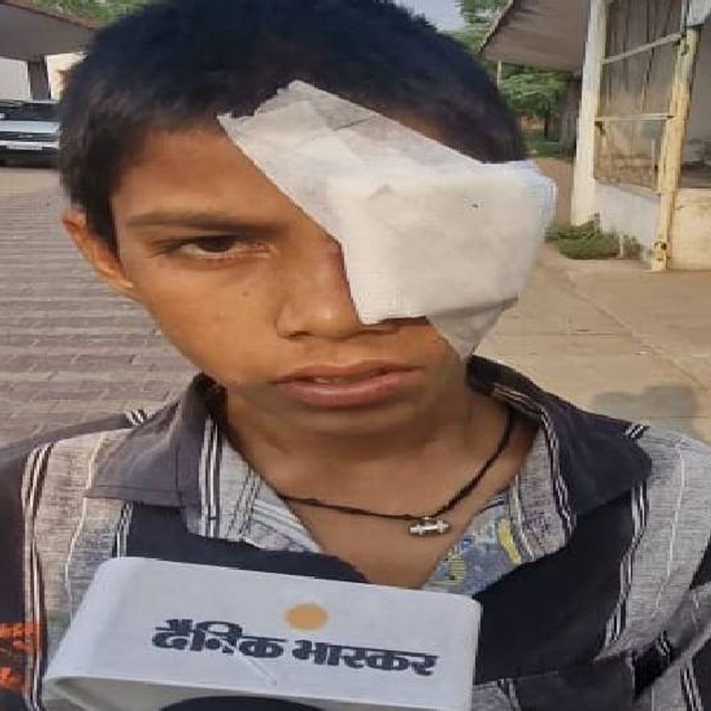 12 साल के बच्चे की आंख में फूटा पटाखा:झांसी में पोटाश भरकर चला रहा था पाइप गन, बैक मारने से आंख डेमेज