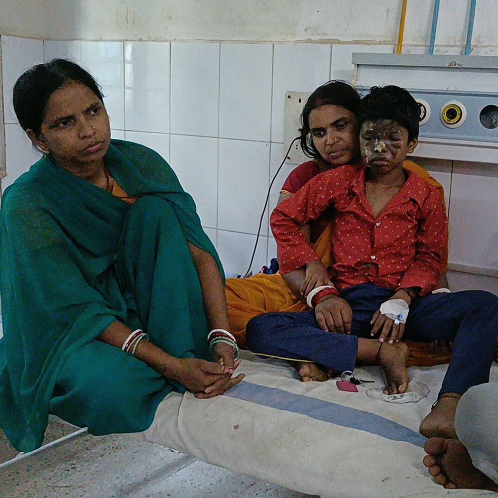 दीपावली पर पटाखे की चिनगारी से 2 बच्चे झुलसे:जमुई में एक की हालत गंभीर, चेहरा बुरी तरह झुलसा