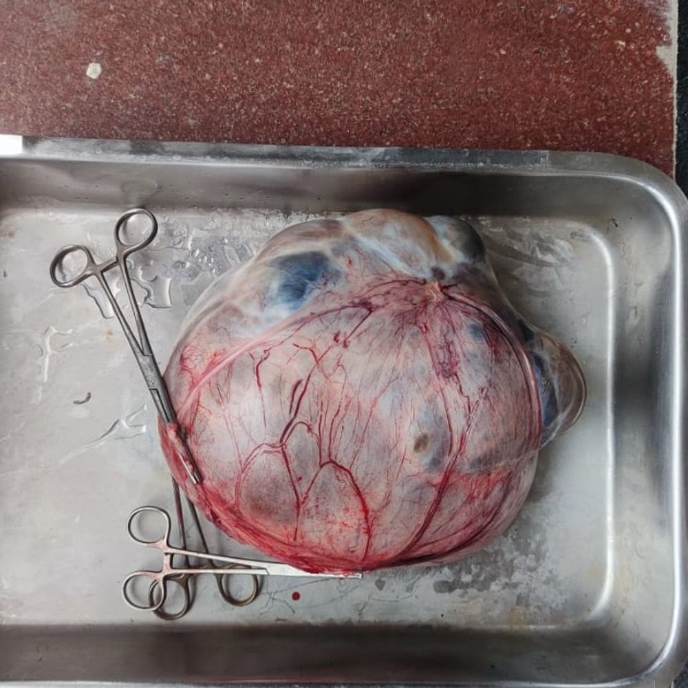 मधेपुरा में महिला के पेट से निकला 5KG का ट्यूमर:एक साल से थी परेशान, सर्जरी के बाद हालत सामान्य