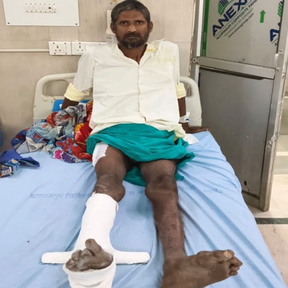 लखनऊ के बलरामपुर अस्पताल में कूल्हे का हुआ निशुल्क इम्प्लांट:40 साल का संजय सड़क हादसे में हुआ था घायल, निदेशक ने 20 हजार देकर सर्जरी कराई