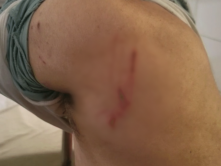 दंपती के बीच विवाद, पत्नी ने कुत्ते से कटवाया:  हजारीबाग में ज्वेलरी पहनने को लेकर हुई बहस, डॉग बाइट से पति की हालत गंभीर, इलाजरत – Hazaribagh News