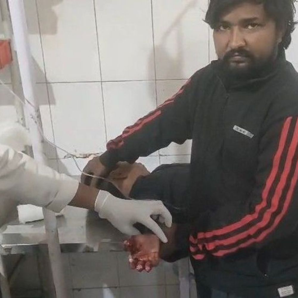 सीतापुर में पटाखा दगने से मासूम का हाथ फटा:बर्थडे पार्टी से लाए पटाखे से हुआ हादसा, हालत गंभीर,जिला अस्पताल में भर्ती