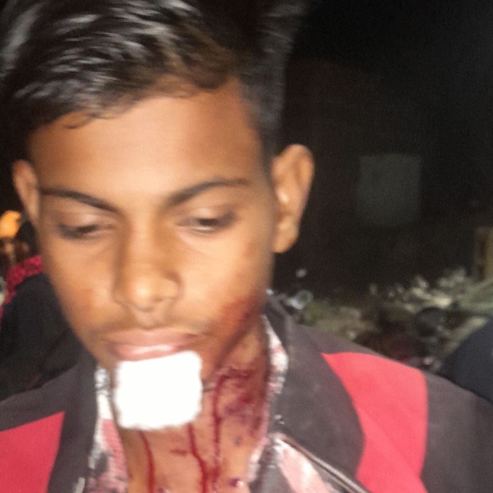 अलीगढ़ में अलाव ताप रहे किशोर को गोली मारी:अज्ञात बाइक सवारों ने किया हमला, हालत गंभीर