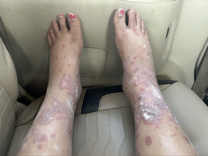 महिला का दावा- अकासा फ्लाइट में बैठकर इंफेक्शन हुआ:सूजे पैरों की तस्वीर शेयर की; घुटने के नीचे पूरे हिस्से में रैशेज पड़े