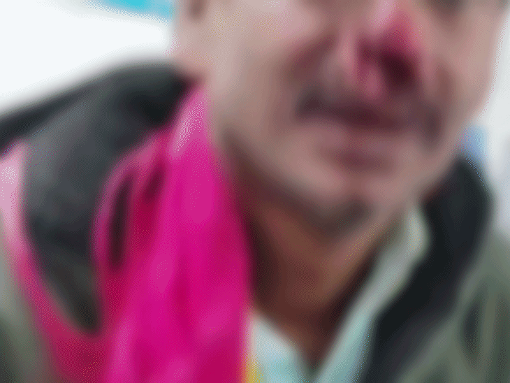 असरगंज में चचेरे भाई ने तलवार से काटी नाक:पत्नी को गाली देने को लेकर हुआ था विवाद, छोटे भाई ने कहा- समझाने गए थे, पर उसने हमला कर दिया