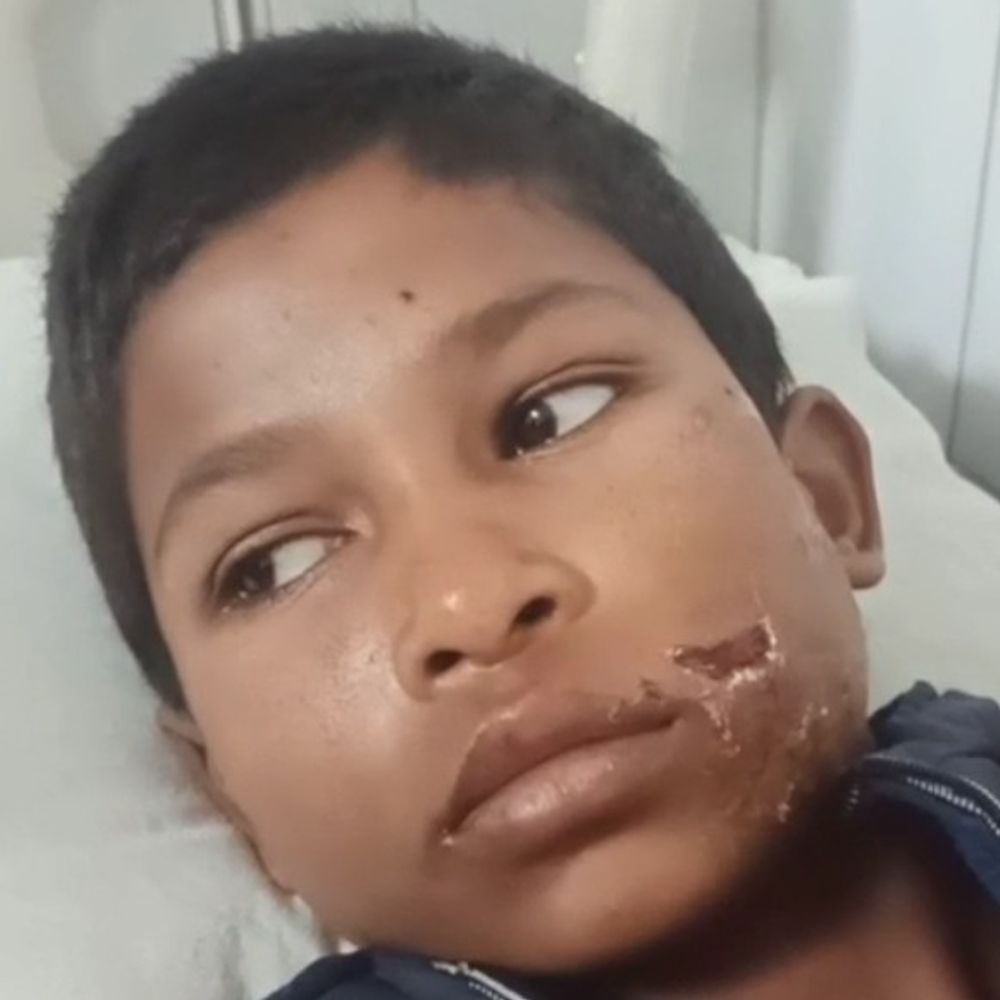 बहराइच में आवारा कुत्तों ने दो लोगों को काटा:एक बुजुर्ग और किशोर घायल, जिला अस्पताल में भर्ती