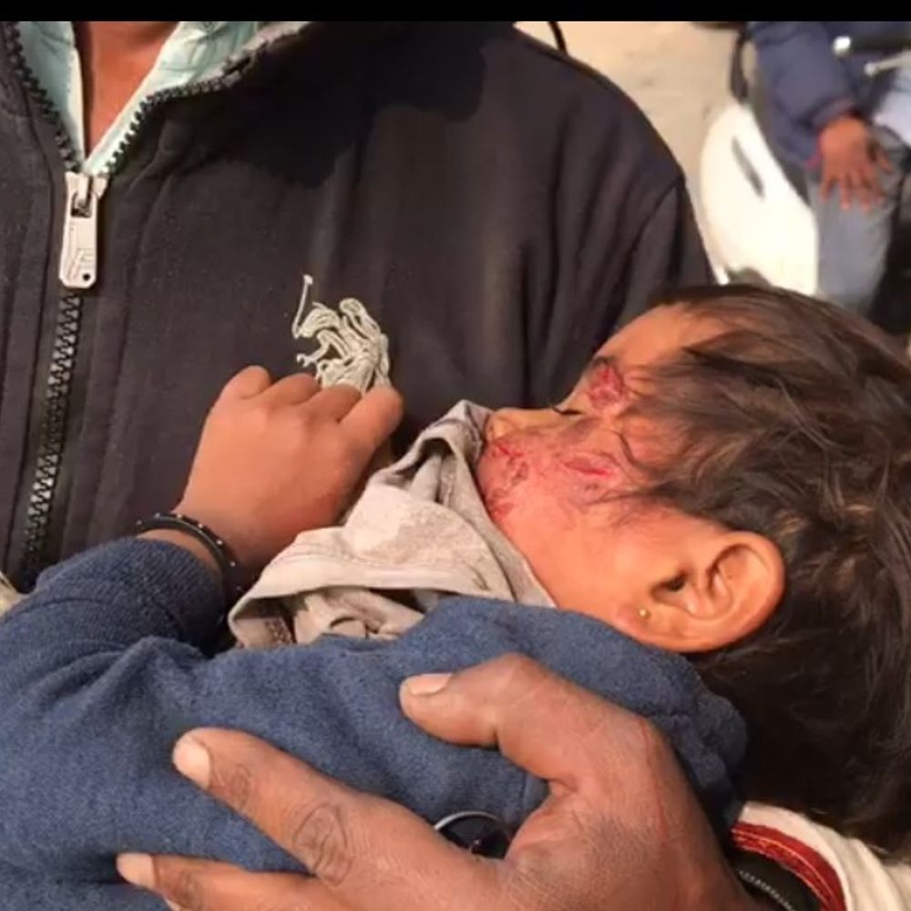 सतना में 5 साल की बच्ची को कुत्ते ने काटा:घर के बाहर खेलते समय चेहरा नोचा, जिला अस्पताल रेफर