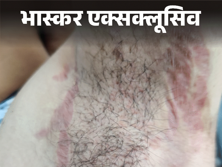 स्किन डिजीज में क्रीम जला रहीं स्किन:18 क्रीम पर अलर्ट जारी, मार्केट में भी बिक रहीं, जली त्वचा के साथ आ रहे मरीज