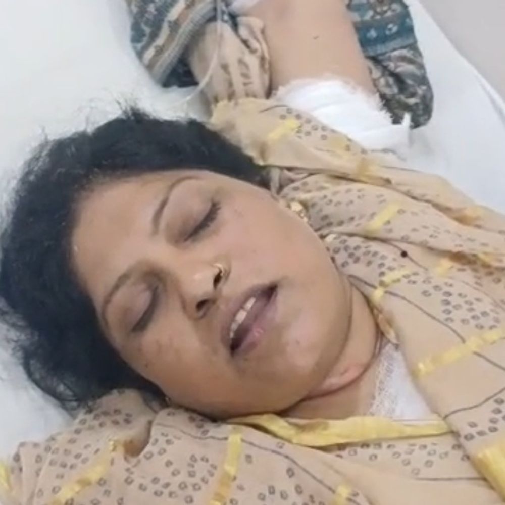 महिला आग से जलती हुई घर से बाहर भागी:सास, ननद-ननदोई और पड़ोसियों पर आग लगाने का आरोप, अस्पताल में भर्ती