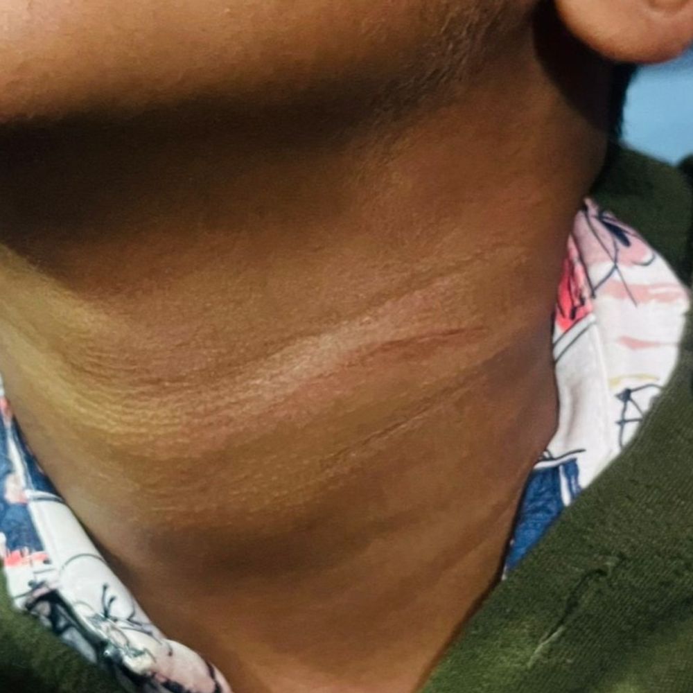 प्रयागराज में मांझे से 6 साल का बच्चा घायल:गले में फंसा, हाथ की उंगली और गले में आई चोट; लगातार दूसरी घटना