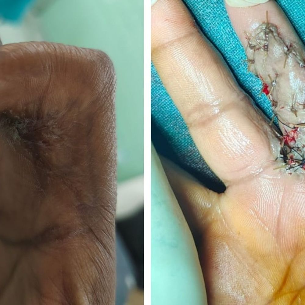 प्रयागराज के केंद्रीय चिकित्सालय में फिंगर की सर्जरी:मशीन दुर्घटना में कुचली उंगली का किया सफल ऑपरेशन