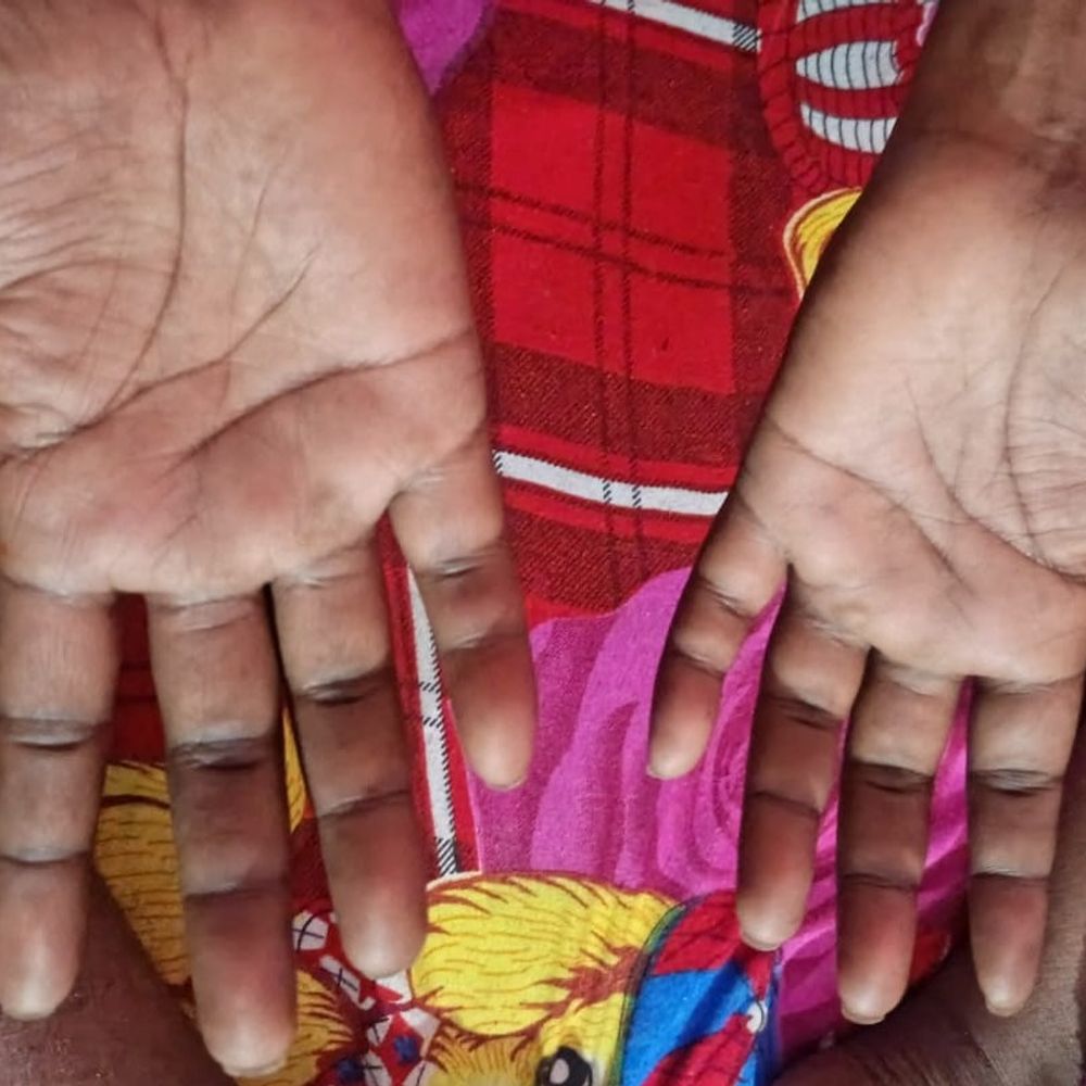 युवक ने बीनागंज चौकी पुलिस पर लगाए मारपीट के आरोप:बोला- मुर्गा बनाया और थर्ड डिग्री दिया; पुलिस बोली- चोरी के मामले में संदेही, आरोप झूठे