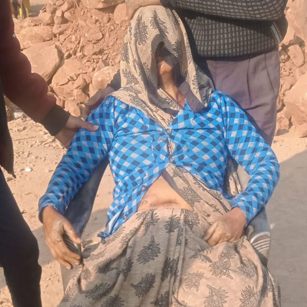 सीधी में शिकार के लिए बिछाए करंट से महिला झुलसी:जंगल में लकड़ी बीनने गई थी, गंभीर हालत में रीवा रेफर