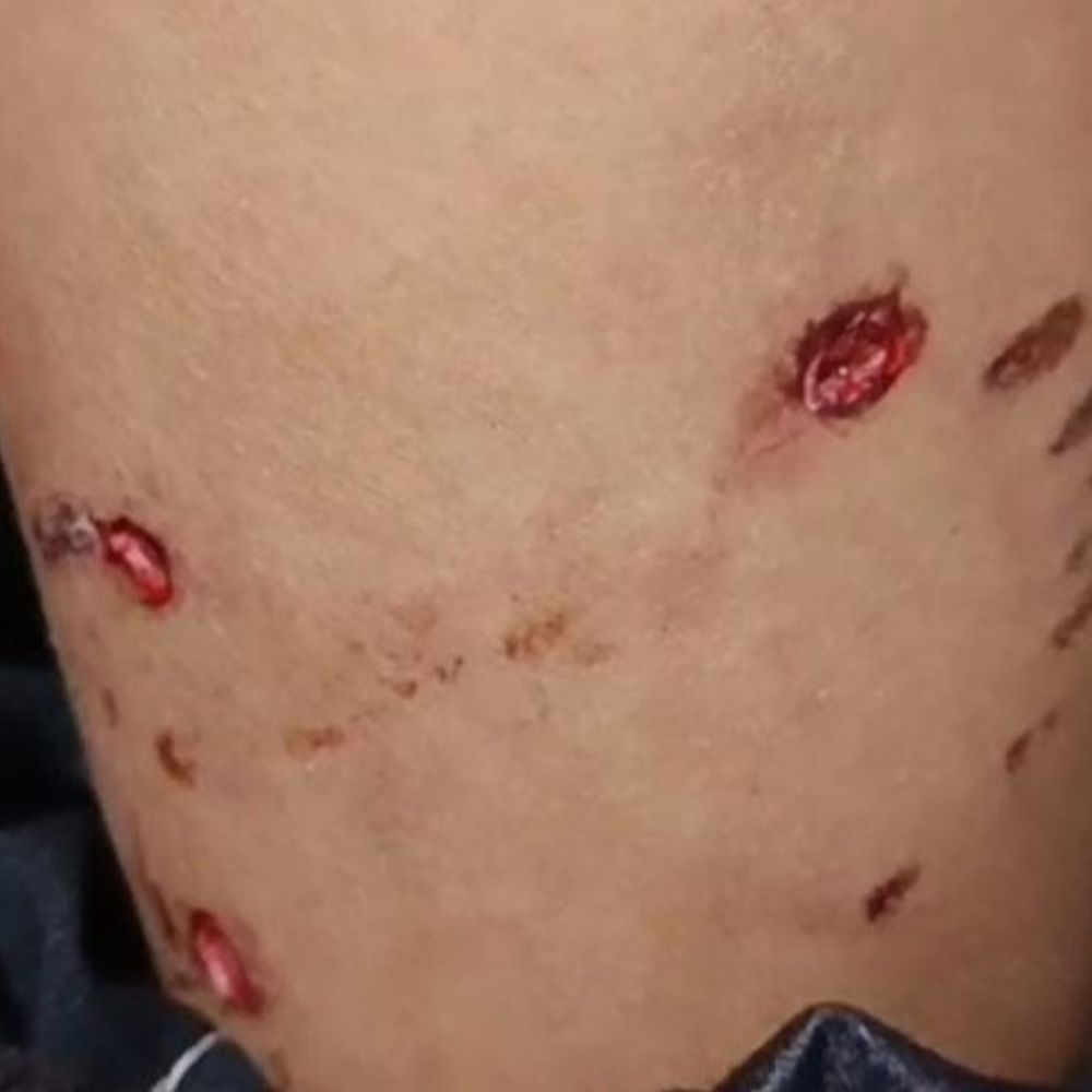 किराने की दुकान गई मासूम पर कुत्ते का हमला:पैर को जबड़े में दबाया, दांत के निशान हुए; छिंदवाड़ा अस्पताल में भर्ती