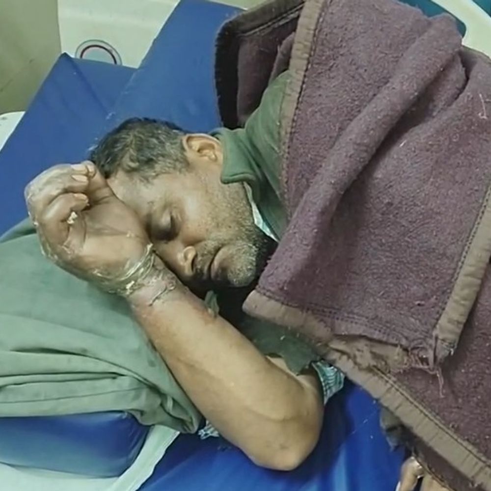 बहराइच में लाइन ठीक करते समय लाइनमैन को लगा करंट:गंभीर रूप से झुलसा, जिला अस्पताल में चल रहा इलाज