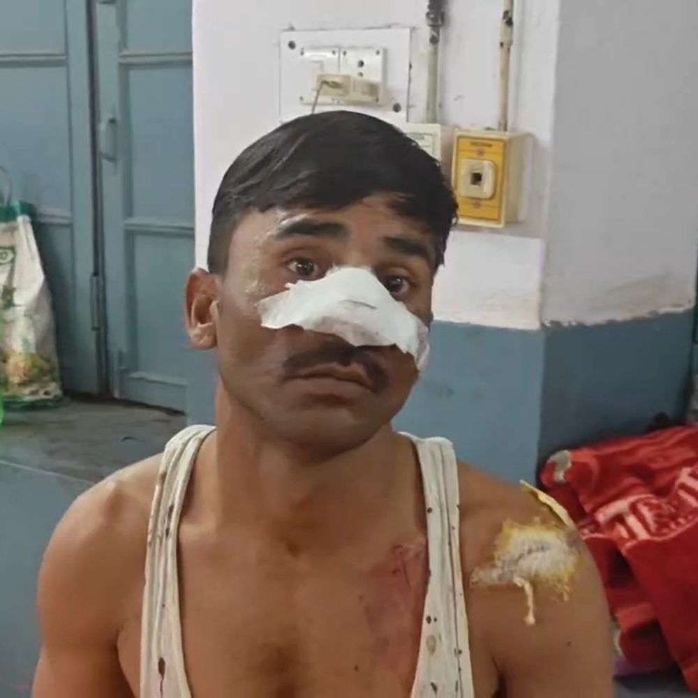 50 रुपये के विवाद में ई-रिक्शा चालक की नाक काटी:मथुरा में चार्जिंग के दौरान विवाद में हमला किया, घायल जिला अस्पताल में भर्ती