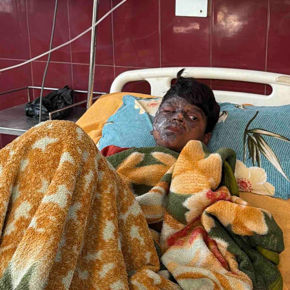 रामपुर में हाइटेंशन की चपेट में आने से किशोर झुलसा:कबूतरों को दाना डालते समय हुआ हादसा, परिजन विभाग पर लगाया लापरवाही का आरोप