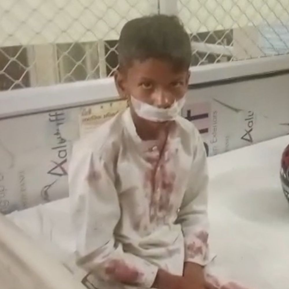 पतंग निकालने पर 10 साल के बच्चे की पिटाई:फतेहपुर में चेहरे पर चोट, होंठ फटा; अस्पताल में भर्ती