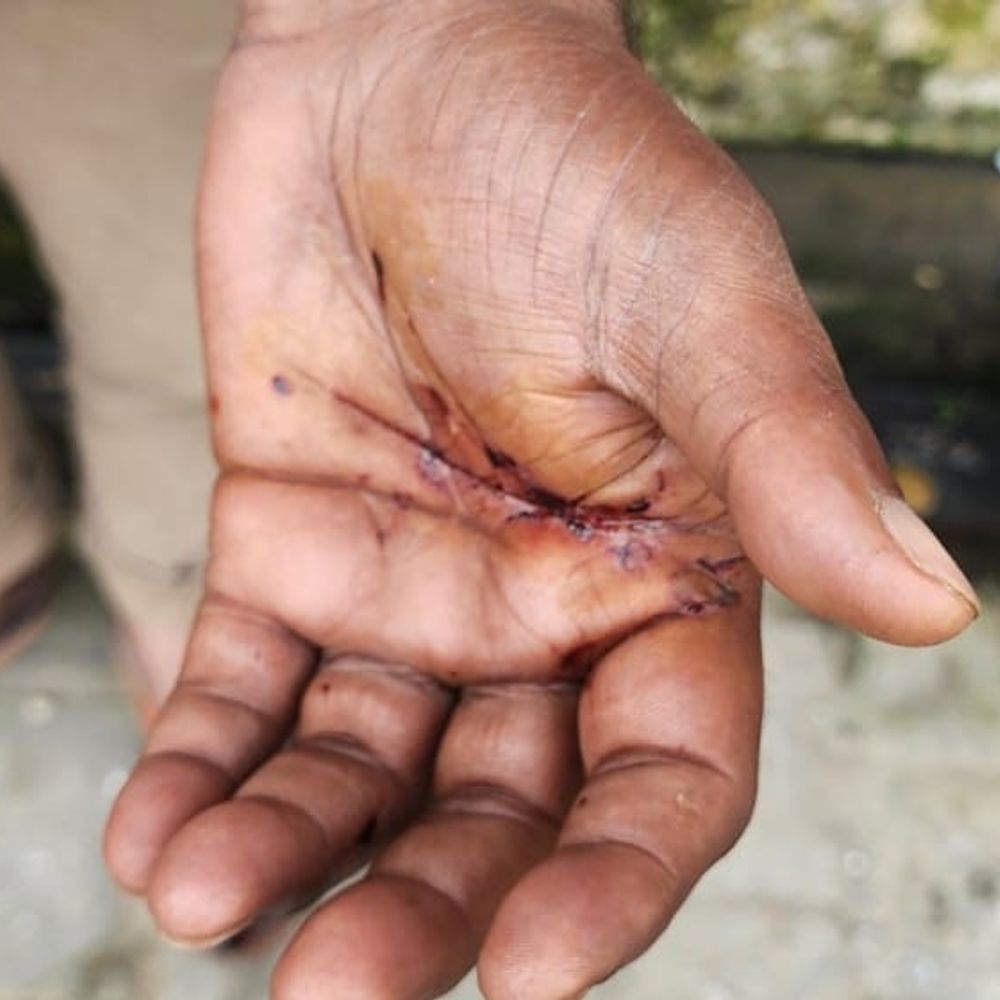 बिजनौर में आवारा कुत्ते ने बच्चे पर हमला किया:बचाने आए पिता को भी काटा, अस्पताल में भर्ती, दुकान से सामाने लेने जा रहे थे