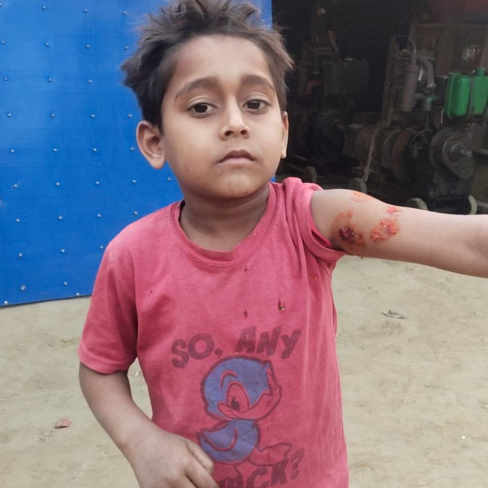 बाराबंकी में कुत्ते ने दो बच्चों को नोचा:घर के बाहर खेल रहे थे, मासूमों के चेहरे और हाथ में गंभीर घाव